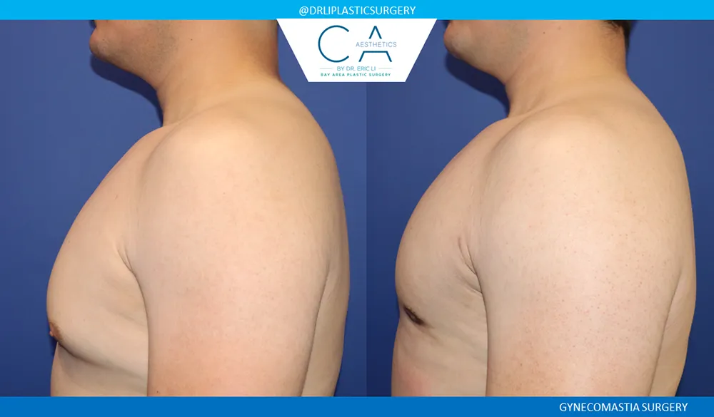 Gynecomastia case #9099
