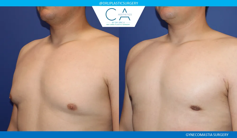 Gynecomastia case #9099