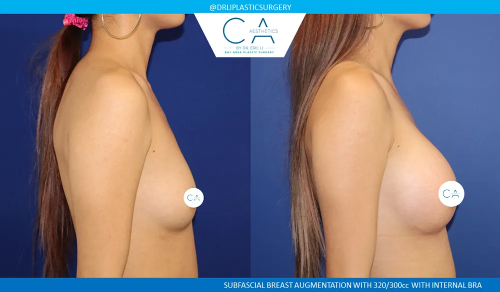 Asian Breast Augmentation case #8937