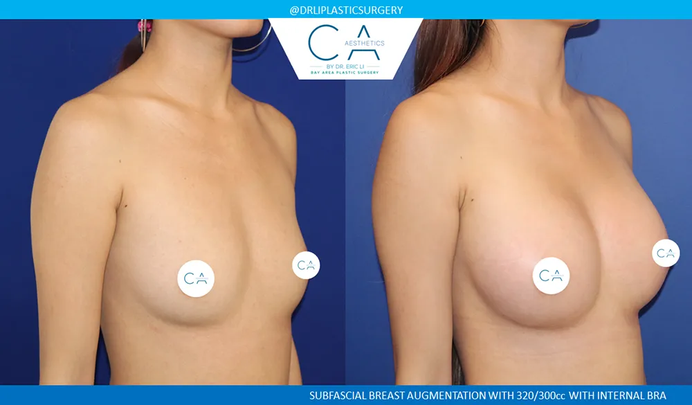 Asian Breast Augmentation case #8937