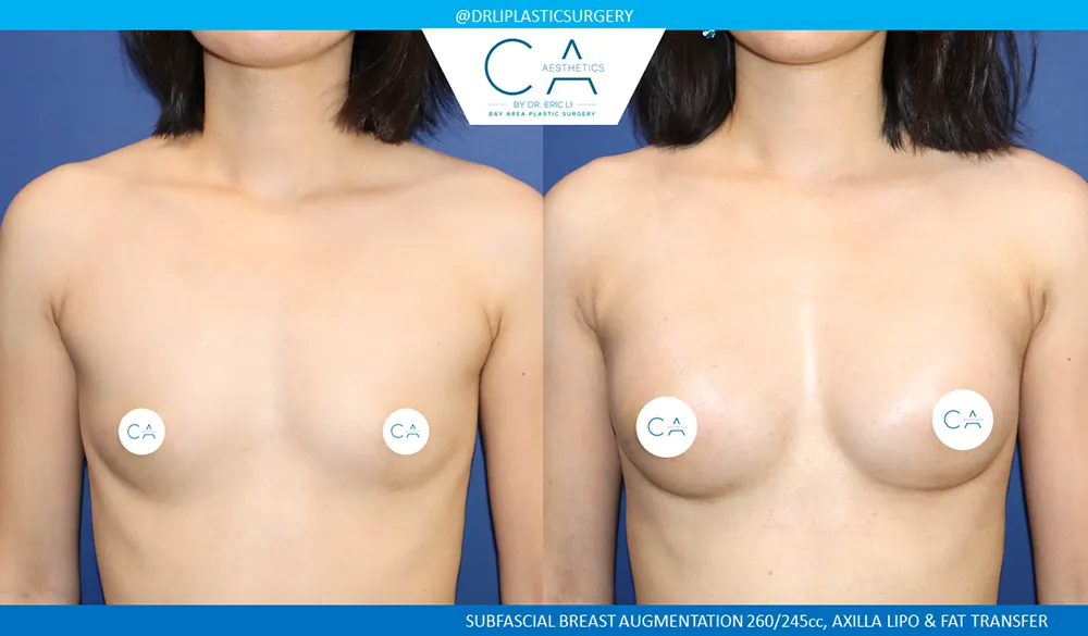 Asian Breast Augmentation case #8942