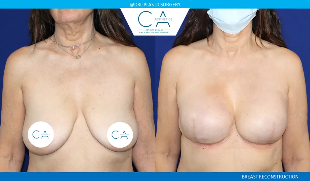 Breast Reconstruction case #9047