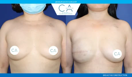 Breast Reconstruction case #9045