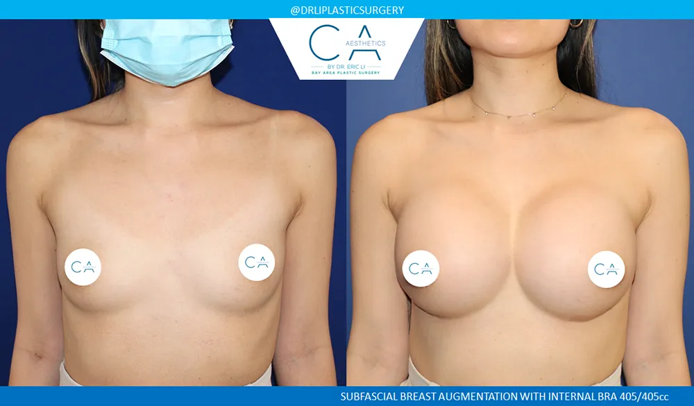 Asian Breast Augmentation case #8949