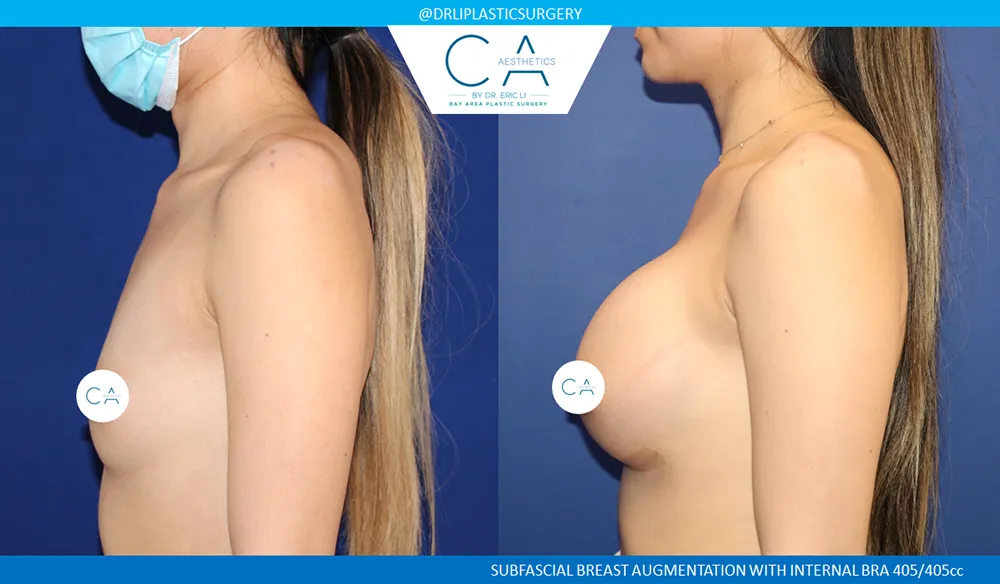 Asian Breast Augmentation case #8949