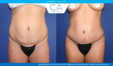 Tummy Tuck case #9128