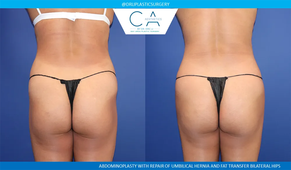 Tummy Tuck case #9128