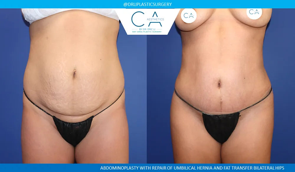 Tummy Tuck case #9128