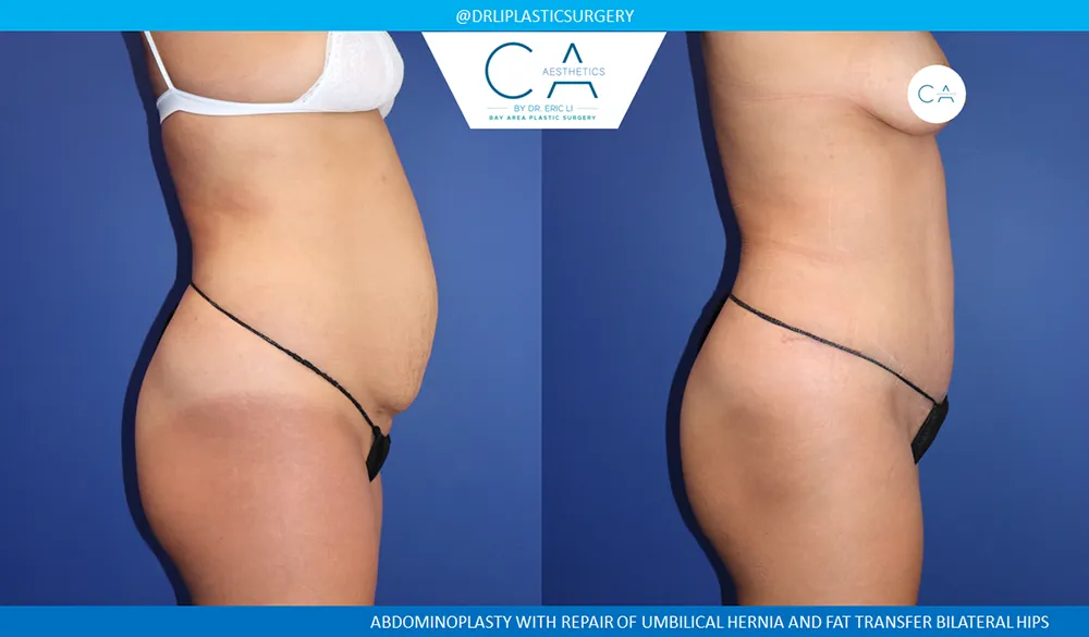 Tummy Tuck case #9128