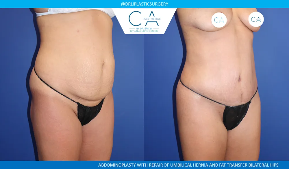 Tummy Tuck case #9128