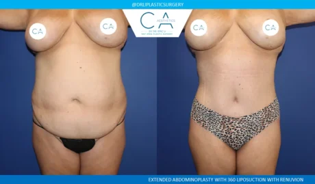 Tummy Tuck case #9133