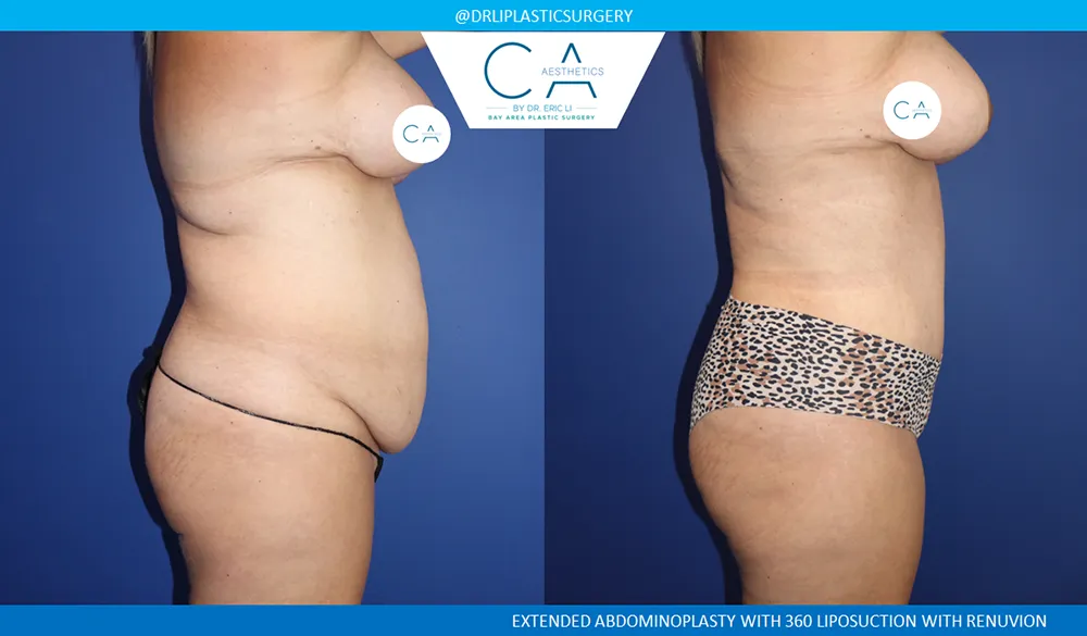 Tummy Tuck case #9133