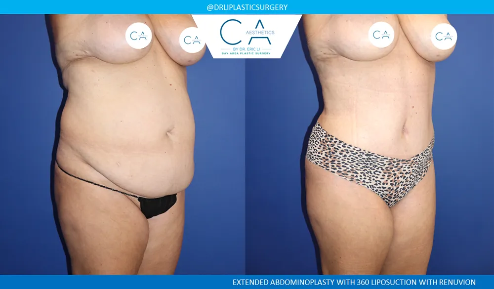 Tummy Tuck case #9133