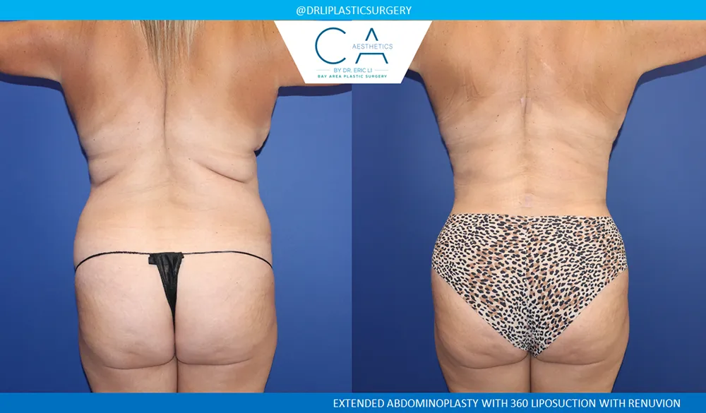 Tummy Tuck case #9133