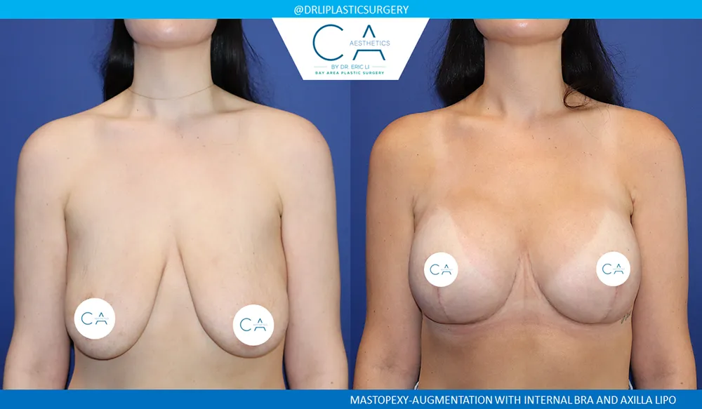 Breast Lift case #9025