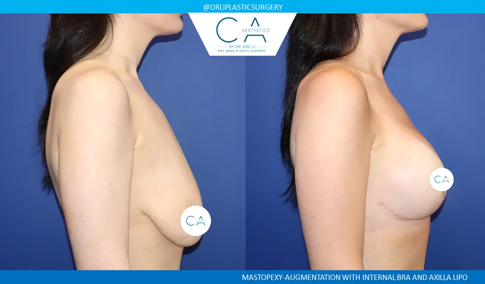Breast Lift case #9025