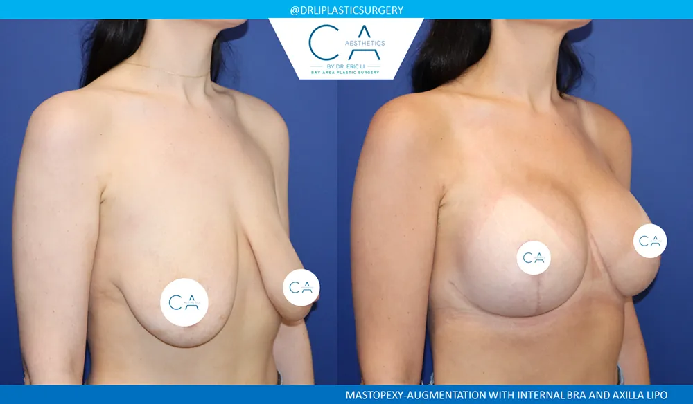 Breast Lift case #9025