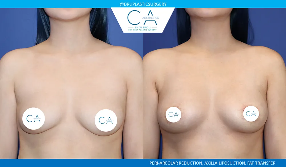 Breast Lift case #9029