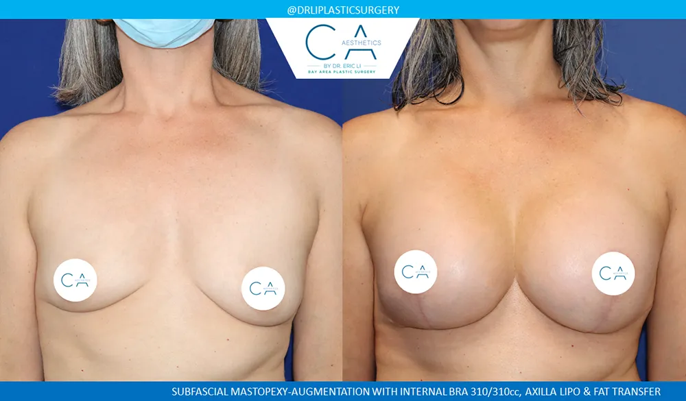 Breast Lift case #9033