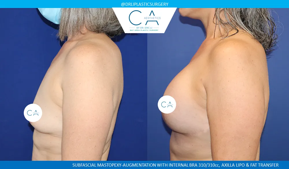 Breast Lift case #9033