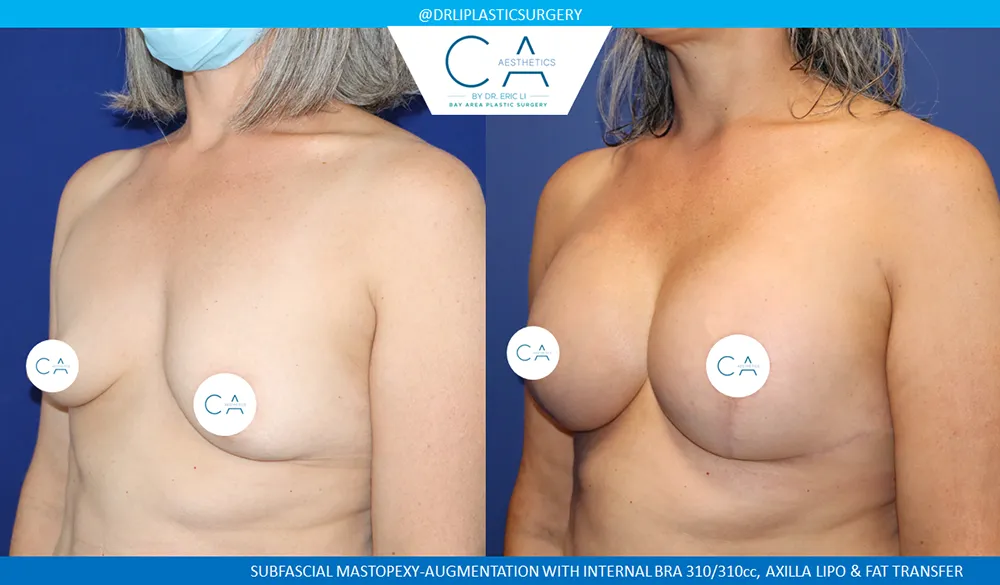 Breast Lift case #9033