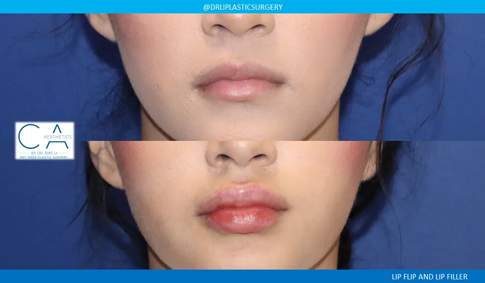 Fillers case #9080