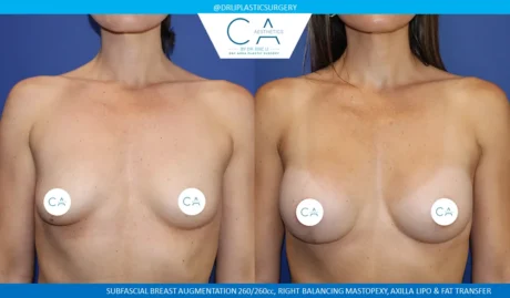 Breast Lift case #9041