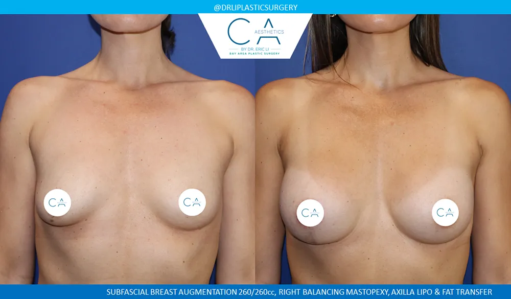 Breast Lift case #9041