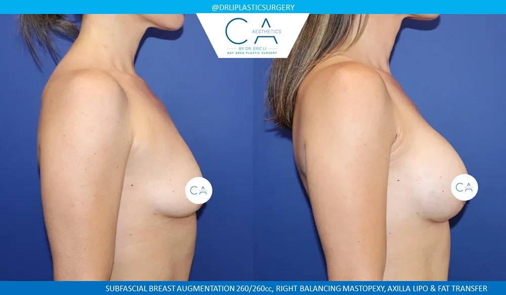 Breast Lift case #9041