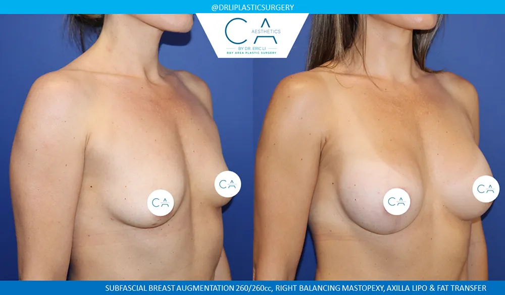 Breast Lift case #9041