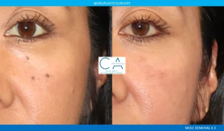 Mole Removal and Scar Revision case #9122