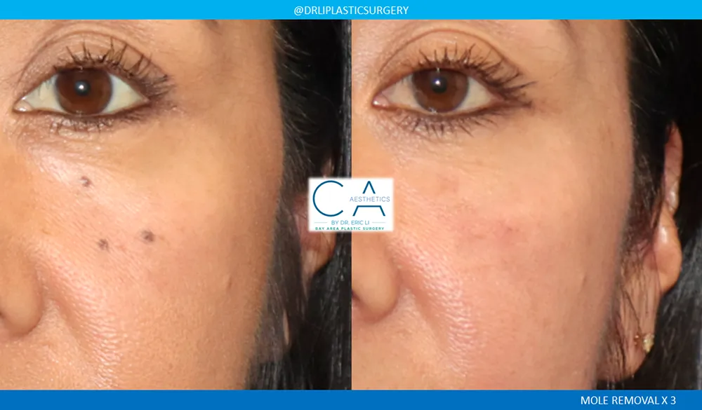 Mole Removal and Scar Revision case #9122