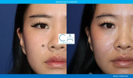 Mole Removal and Scar Revision case #9119