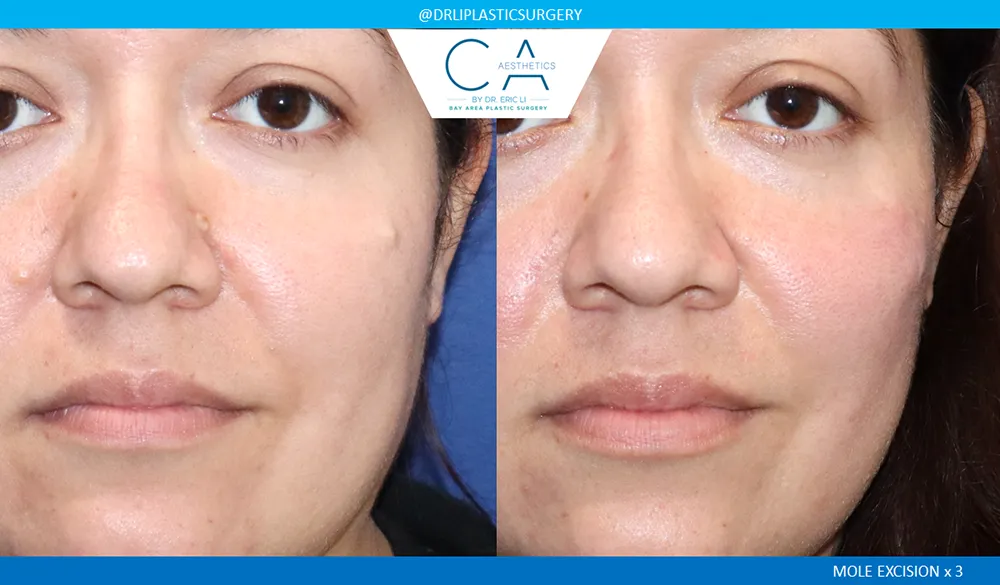 Mole Removal and Scar Revision case #9117
