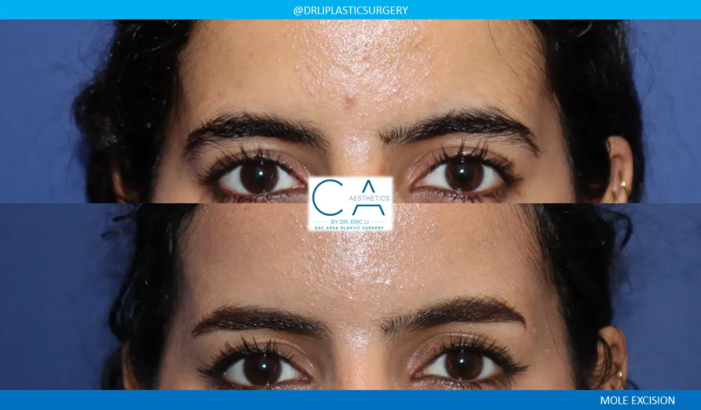 Mole Removal and Scar Revision case #9115