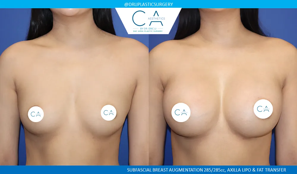 Breast Augmentation case #8986