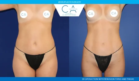 360 Liposuction (Torso) case #8953