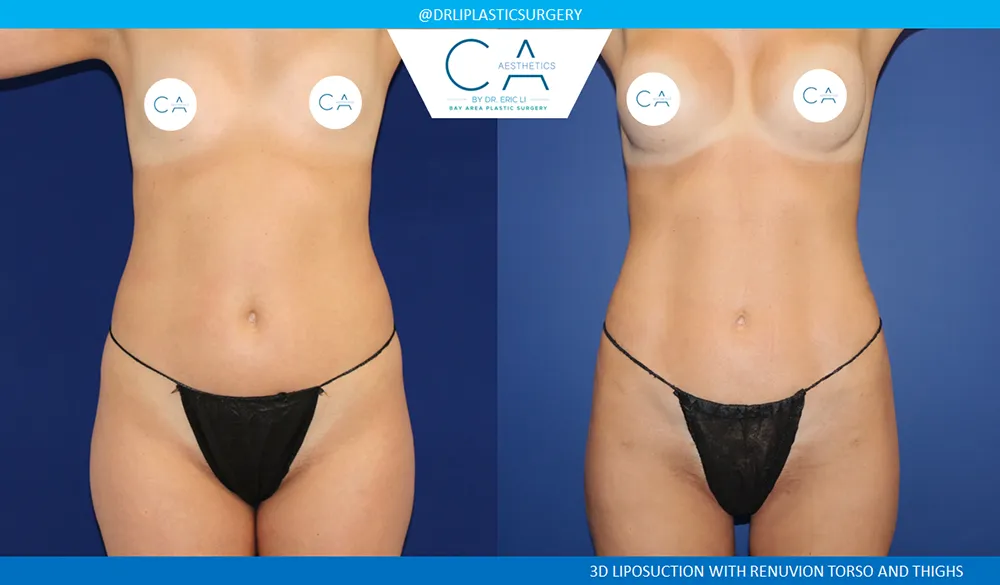 360 Liposuction (Torso) case #8953