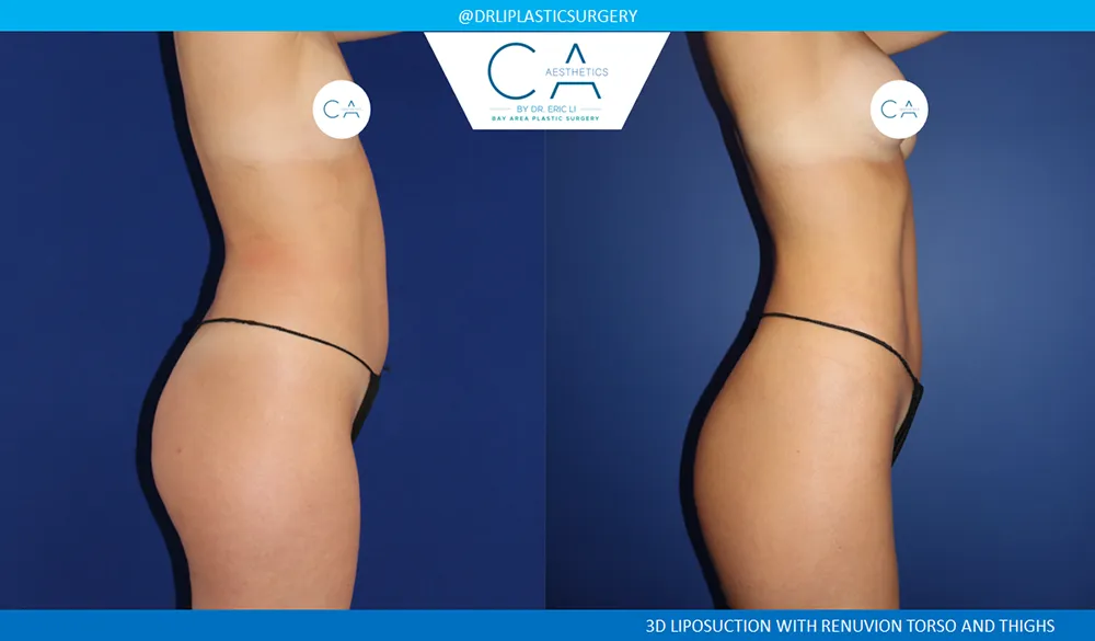 360 Liposuction (Torso) case #8953