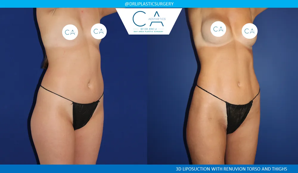 360 Liposuction (Torso) case #8953