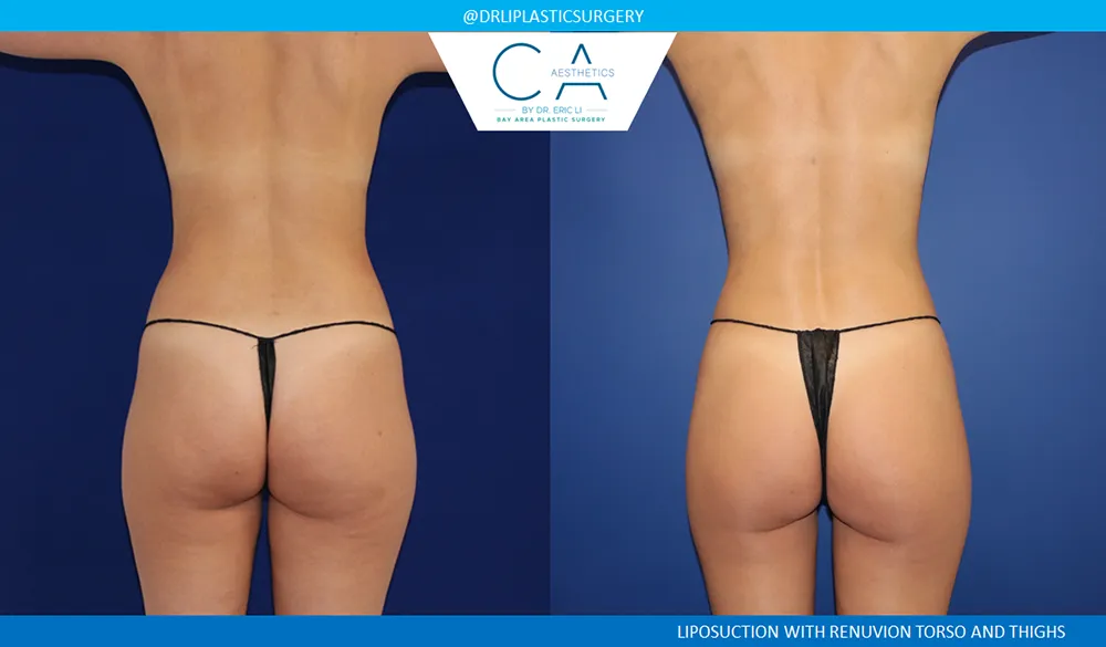 360 Liposuction (Torso) case #8953