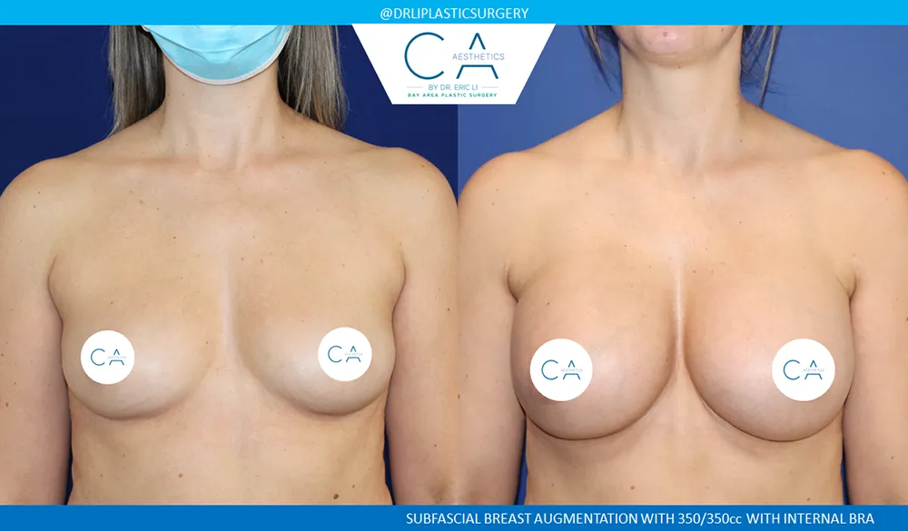 Breast Augmentation case #8990