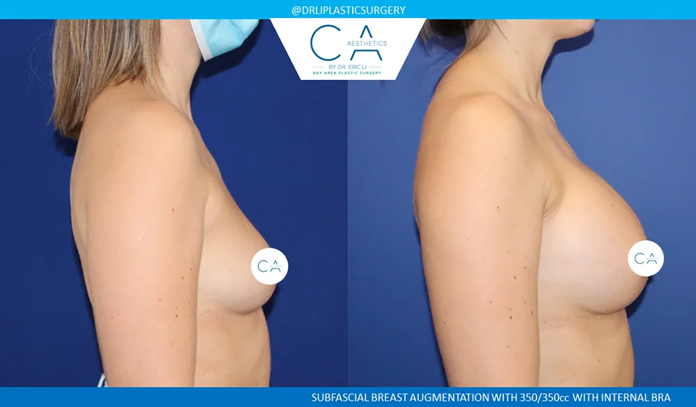 Breast Augmentation case #8990