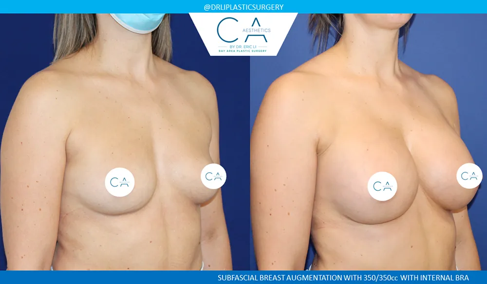 Breast Augmentation case #8990