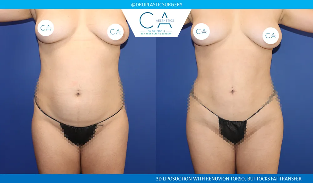 360 Liposuction (Torso) case #8958