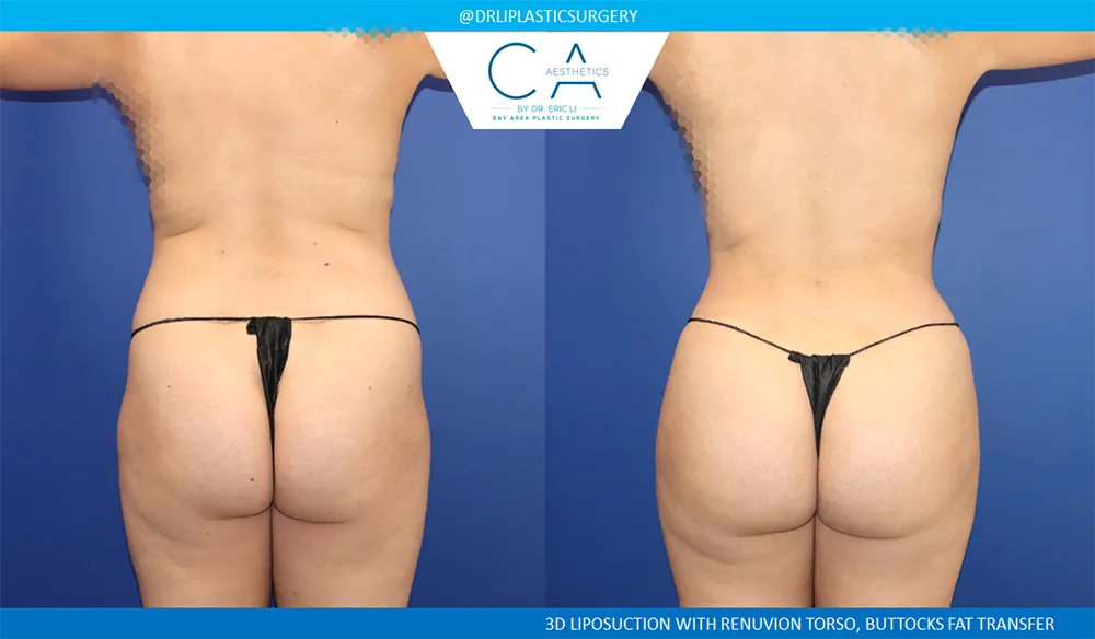 360 Liposuction (Torso) case #8958