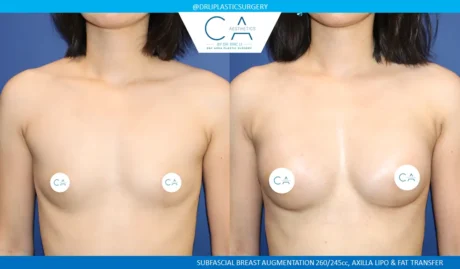 Breast Augmentation case #8994