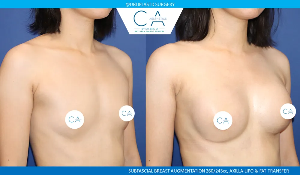 Breast Augmentation case #8994