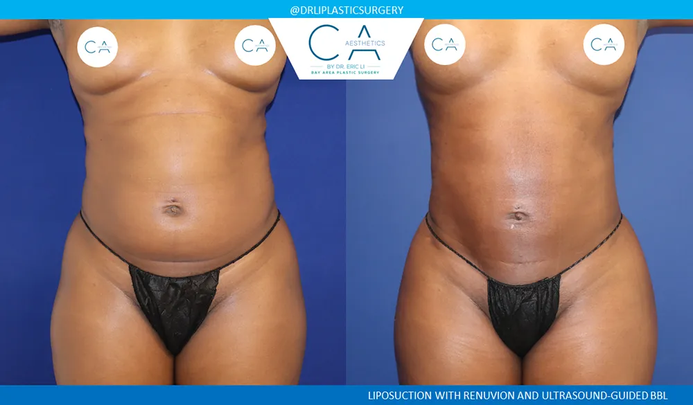 360 Liposuction (Torso) case #8963