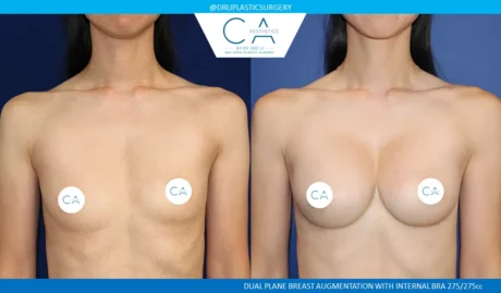 Breast Augmentation case #8997